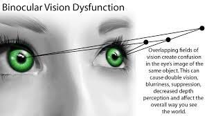 Binocular vision is defined and the motor system and sensory system underlying binocular vision are summarised.

https://visionandperception.com.sg/binocular-vision-assessment/