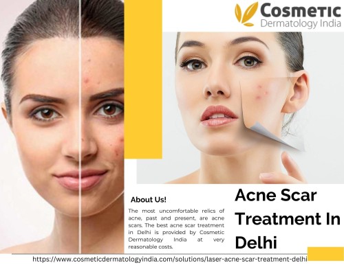 Acne-Scar-Treatment-In-Delhi.jpg