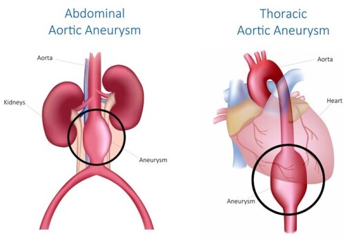 Aortic-Aneurysm-Tampa-1.jpg