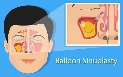 BalloonSinuplasty.jpg